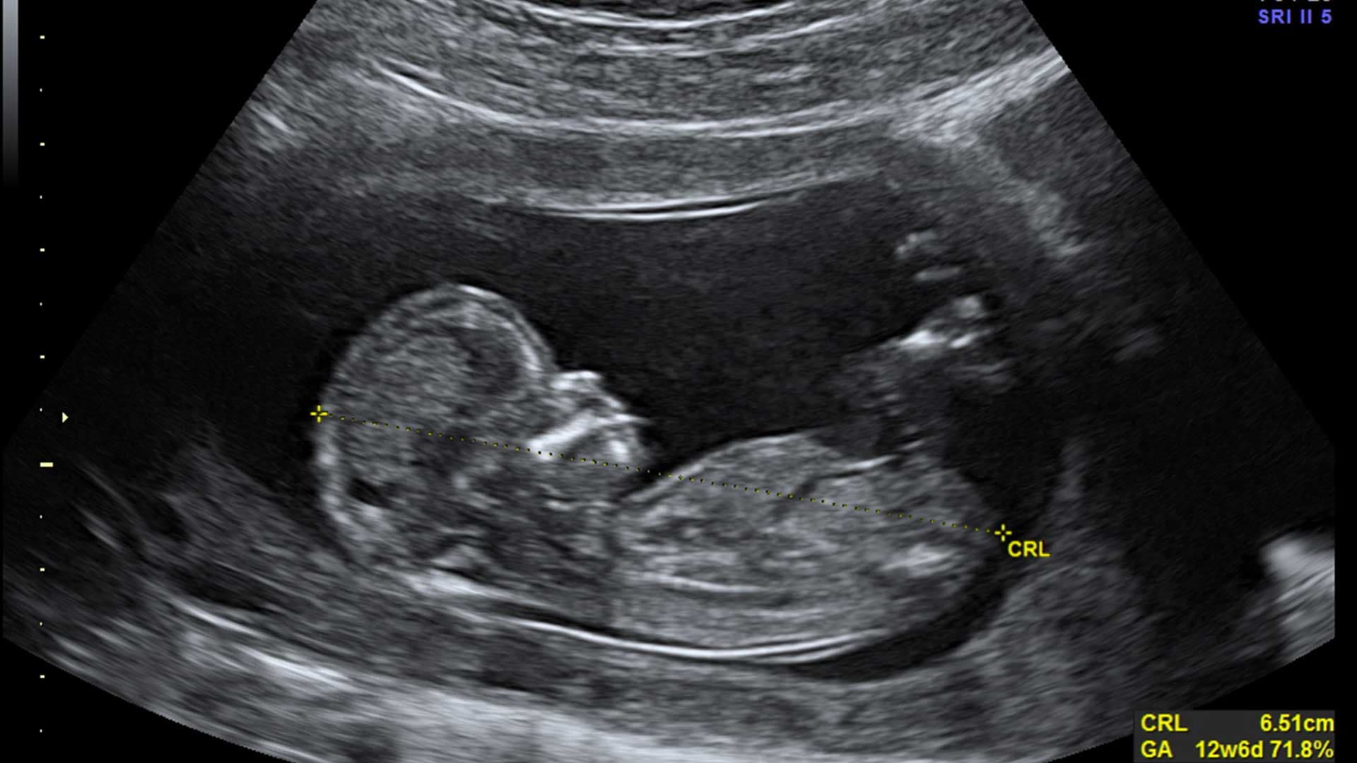 Des particules de microplastiques découvertes dans des foetus